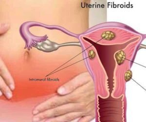 Miracle traditionnel : traitement 100% efficace des fibromes utérins.