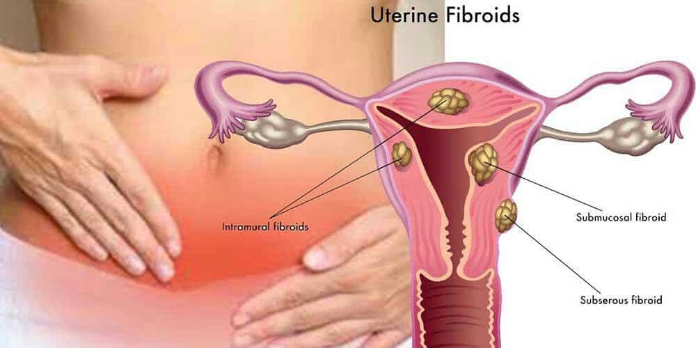 Miracle traditionnel : traitement 100% efficace des fibromes utérins.