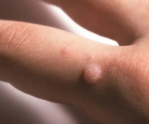 Qu’est-ce que les condylomes et comment soigner des condylomes?