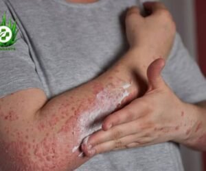 Voici comment Prévenir et Traiter les Mycoses Naturellement avec amansante.com